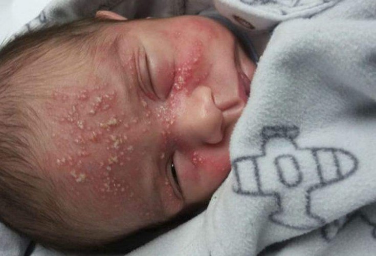Bebê é internado após contrair herpes depois de beijo de visita