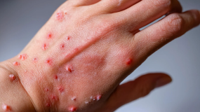 Primeiro paciente com Mpox em Linhares recebe alta hospitalar